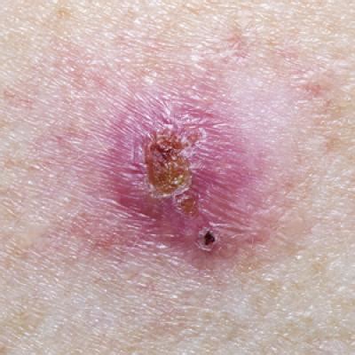 Reporting Biopsy Margin Status for Cutaneous Basal Cell Carcinoma…