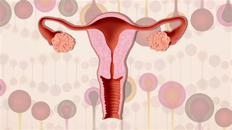 Researchers Identify 2 Types of PCOS Based on Genetic Differences Everyday Health