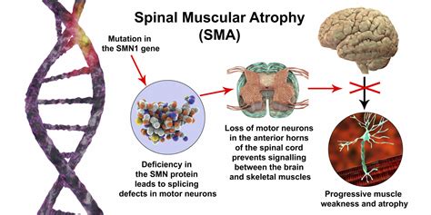 Researchers Identify Genetic Mutation Causing Rare Form of Spinal Muscular Atrophy