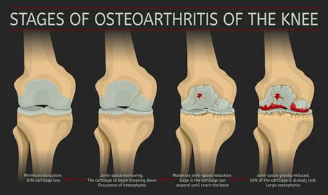 Researchers identify genes at play in people with osteoarthritis