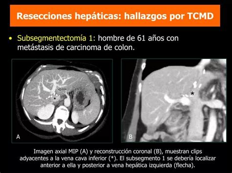 Resecciones hepáticas segmentarias por laparotomía