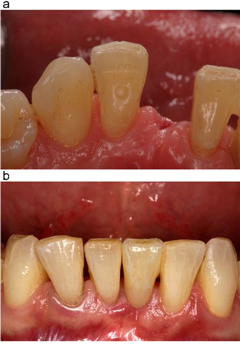 Read Online Resinbonded Fixed Dental Prostheses Minimally Invasive Ã Esthetic Ã Reliable By Matthias Kern