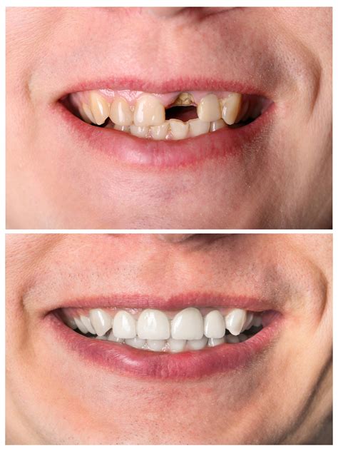 Restoration dentistry. It’s a mixture of plastic (acrylic) resin that’s reinforced with a powdered glass filler. It’s useful for a variety of dental restorations, including. fillings. veneers. inlays. crowns ... 