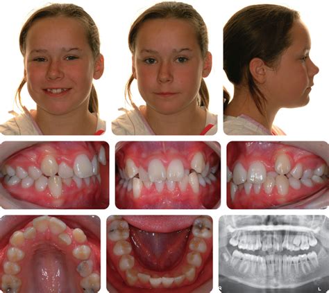 Restoration of a Class I Malocclusion Case Inside Dentistry