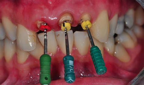 Read Restoration Of Root Canaltreated Teeth An Adhesive Dentistry Perspective By Jorge Perdigao