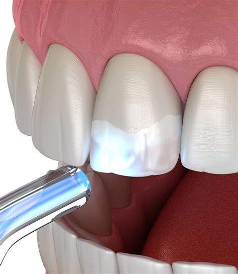 Restorative Dentistry in Lower Merion - Narberth Dental