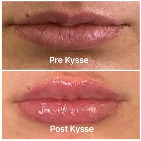 Restylane Kysse Price