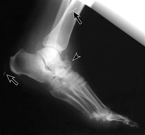 th?q=Retained Needle Fragments in Patients With Diabetic Neuropathy
