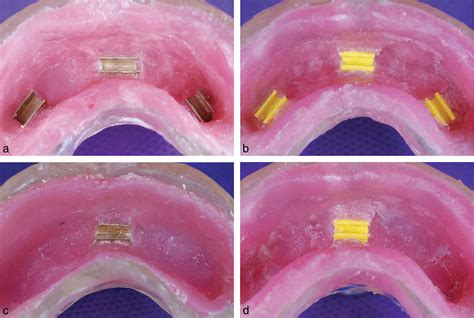 Retention of implant-supported overdenture with bar/clip and stud ...