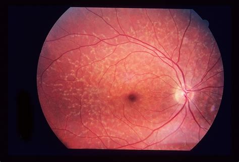 Reticular retinal dystrophy (Concept Id: C4024776)