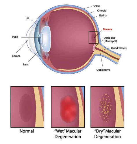 Retina Albuquerque Retina Surgery Santa Fe Eye NM