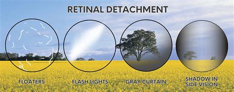 Retinal Detachment 3 Most Common Warning Signs