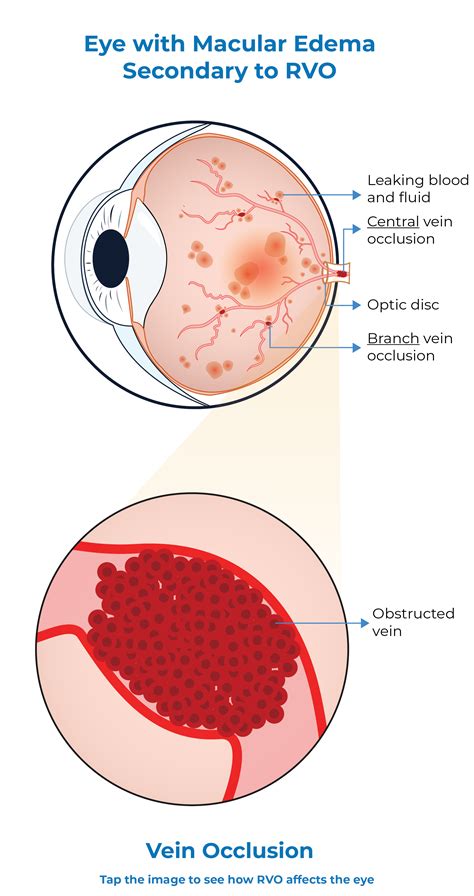 Retinal Vein Occlusion (RVO): What It Is, Causes & Treatment