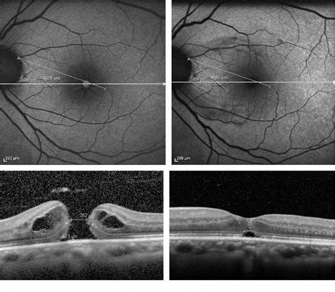 Retinal displacement toward optic disc after internal limiting …