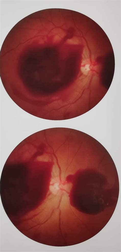 Retinal hemorrhage of late post‐COVID‐19 and …