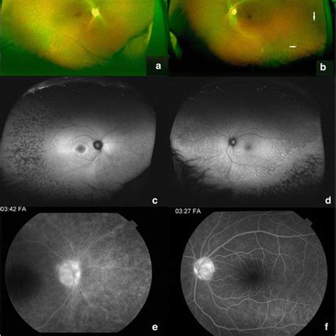 Retinal pigmentary changes in chronic uveitis mimicking retinitis ...