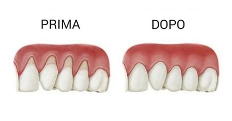 Retrazione gengivale? 8 Rimedi che Stimolano la Crescita