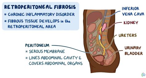 Retroperitoneal fibrosis symptoms.  The tissue is generally localized Find out about re...