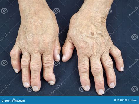 Reumatism händer