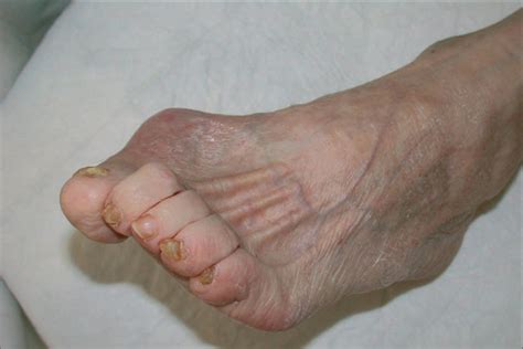 Reversal of toe clawing in the patient with neuropathy by