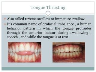 Reverse Swallow Pattern