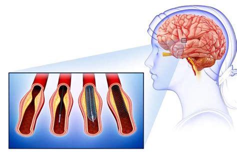 Reversing Cerebral Arteriosclerosis