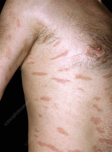 Reversing Retiform Parapsoriasis