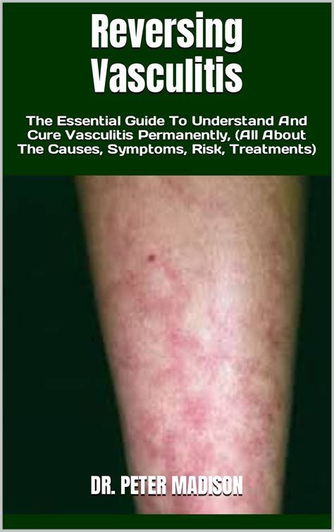 Reversing Systemic Vasculitis