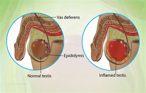 Reversing Testicle Infection