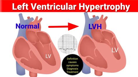 Reversing left ventricular hypertrophy HealthTap Online Doctor