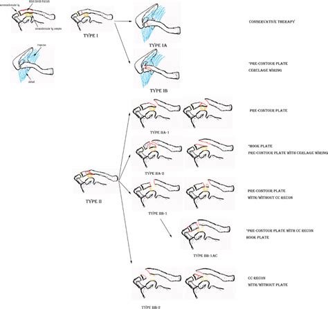 Revising the modified Neer classification for distal clavicle …