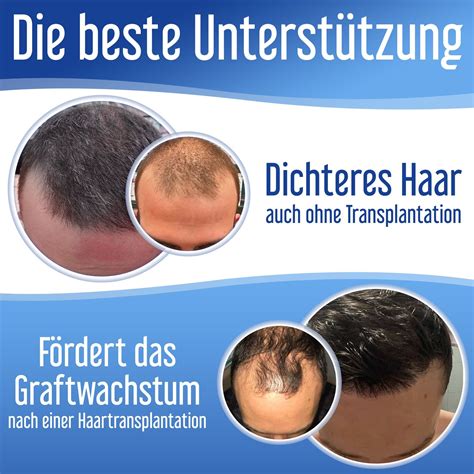 Revolutionäre Lösungen für Haarverlust bei Männern: Nicht-chirurgischer Haarersatz