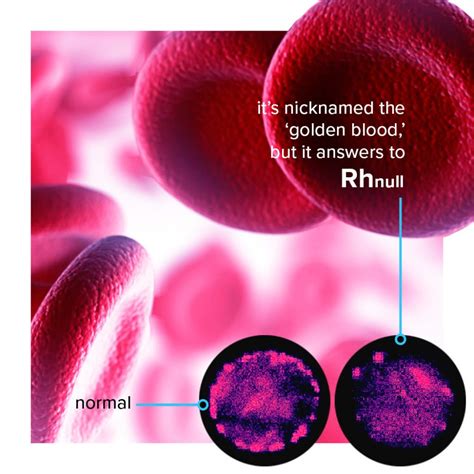 Rh null. Rh-null blood can be accepted by anyone with a rare blood type in the Rh system, making it "the golden blood," says a doctor. International donations are, however, often hampered by bureaucracy. 