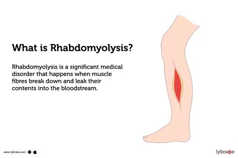 Rhabdomyolysis: Symptoms, Causes, and Treatments - WebMD