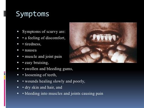 Rheumatic Manifestations of Scurvy: A Report of Three