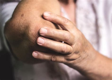 Rheumatoid arthritis How does it affect the elbow 