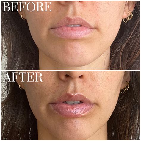 Rhode lip treatment. When Hailey Bieber's skincare line, Rhode, dropped, everything sold out almost instantly and has been getting rave reviews ever since. Their Peptide Lip Treatment is a restorative balm for plump, soft lips, and has over 6,000 reviews and a 4.7-star rating. 