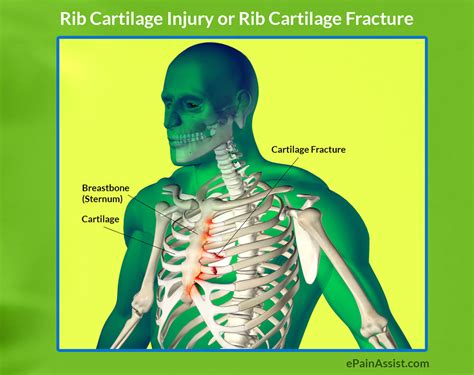 Rib Cartilage Injury: Treatment Causes Symptoms Diagnosis