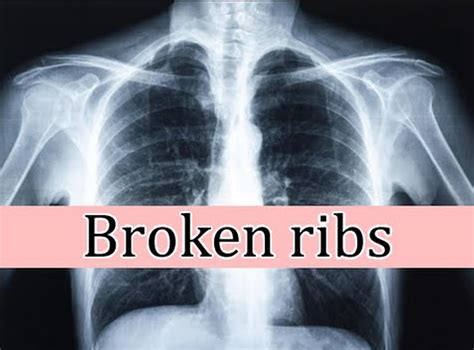 Rib Fracture (Broken Rib): Symptoms, Healing Tips & Treatment