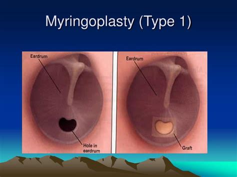 Right Myringoplasty & Ossiculoplasty - YouTube