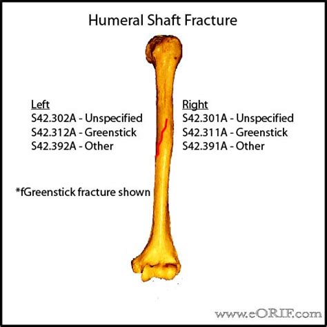 Right humeral fracture icd 10. ICD 10 code for Other nondisplaced fracture of upper end of left humerus, initial encounter for closed fracture. Get free rules, notes, crosswalks, synonyms, history for ICD-10 code S42.295A. 