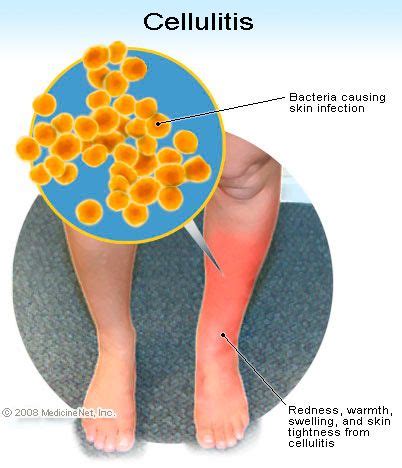 Right lower leg cellulitis icd 10. 2024 ICD-10-CM Range S80-S89. Injuries to the knee and lower leg. Type 2 Excludes. burns and corrosions ( T20 - T32) frostbite ( T33-T34) injuries of ankle and foot, except fracture of ankle and malleolus ( S90-S99) insect bite or sting, venomous ( T63.4) Injuries to the knee and lower leg. S80. 