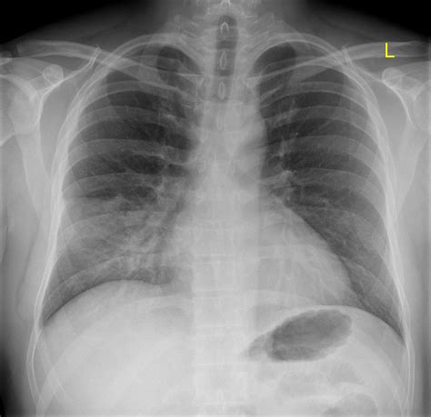 Right middle lobe collapse Radiology Reference …