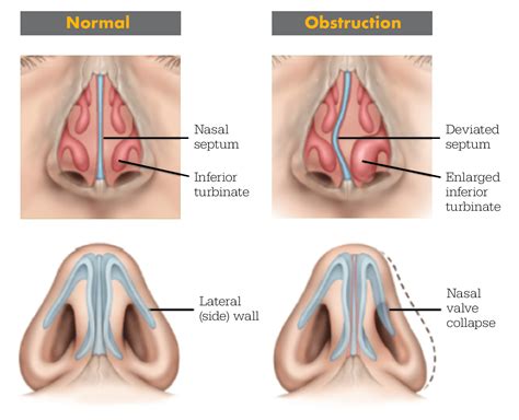 Right nostril always blocked.  Sometimes, it&rsquo;s simply the normal &ldquo;nasal cycle,&rdquo; w...