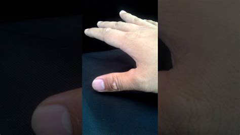 Right thumb twitching. Things To Know About Right thumb twitching. 