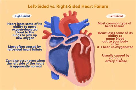 Right-Sided Heart Failure: Symptoms, Treatment, and More