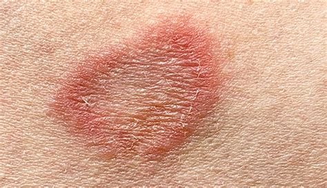 Ringworm images on body. .  <a href=https://stag.der-sinzinger.de/pub/gbkjh/chevrolet-...