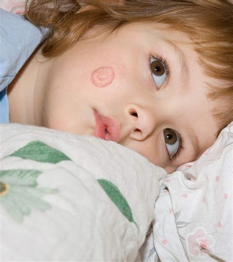 Ringworm in Children Children