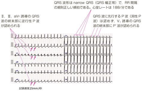 Ripple Mappingの有用性が認められた上室性頻拍の2 - UMIN