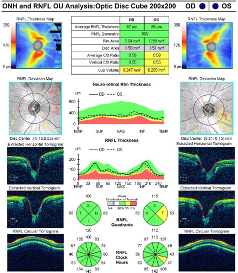 All participants underwent comprehensive ophthalmologic examinations, and their retinas were scanned using 3D OCT-1000. . Rnfl